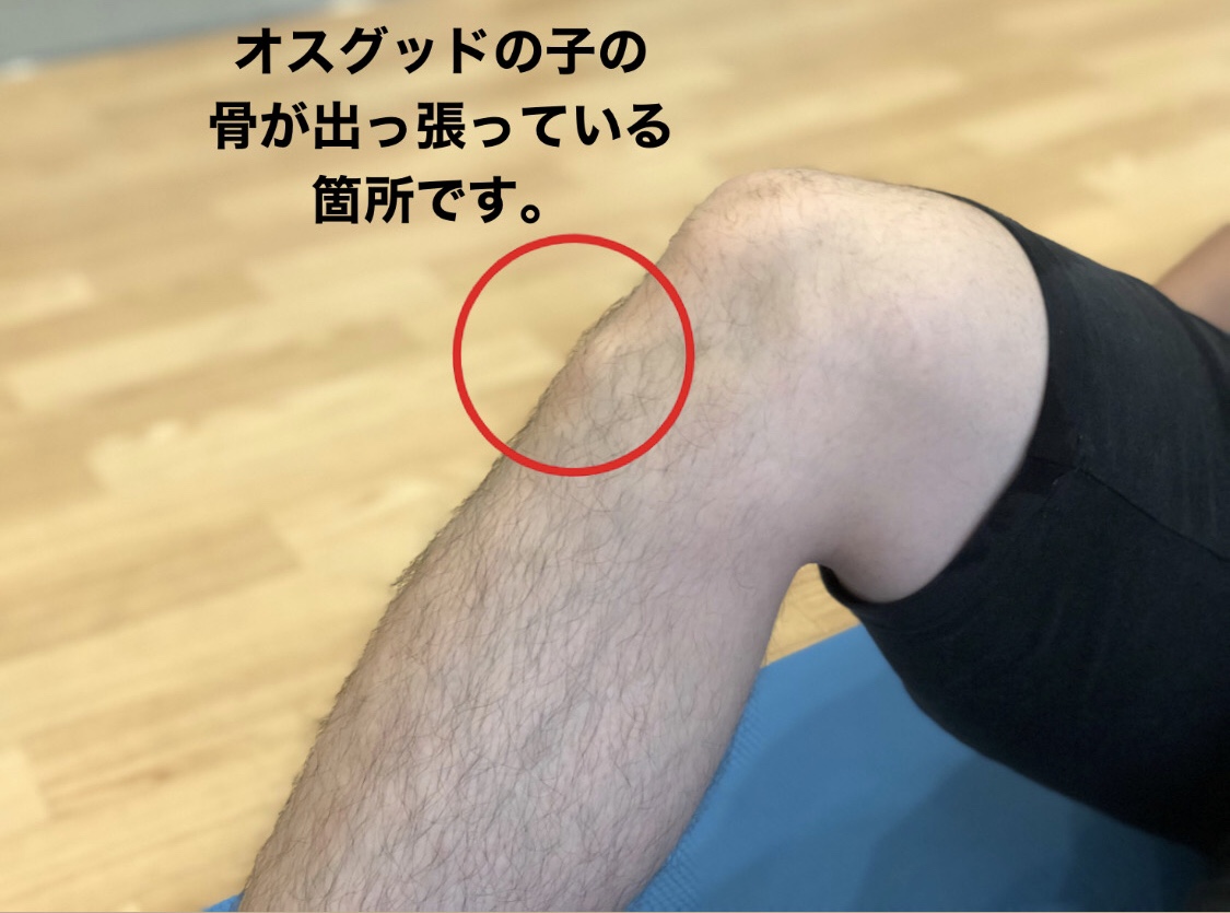 オスグット病について / 武庫之荘・整骨院
