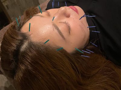 美顔鍼
